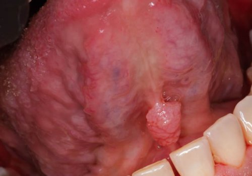 Ιός των ανθρωπίνων θηλωμάτων (HPV) στο στόμα: Τι πρέπει να γνωρίζετε