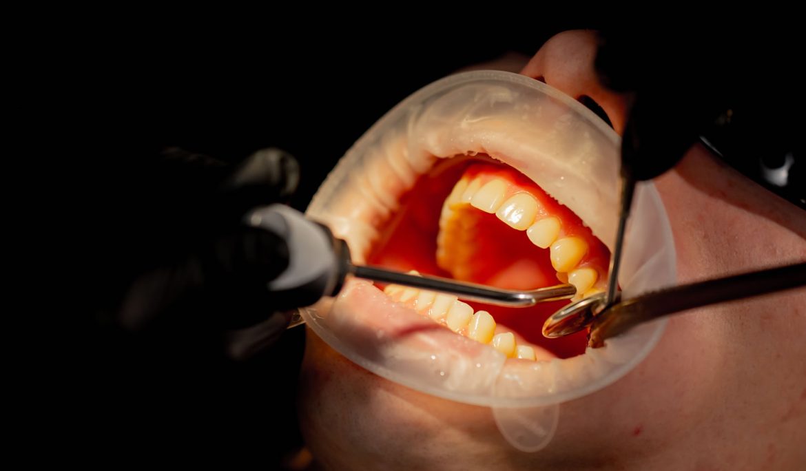 Συμπτώματα ουλίτιδας και αιμορραγία ούλων – οδοντίατρος στη Λαμία