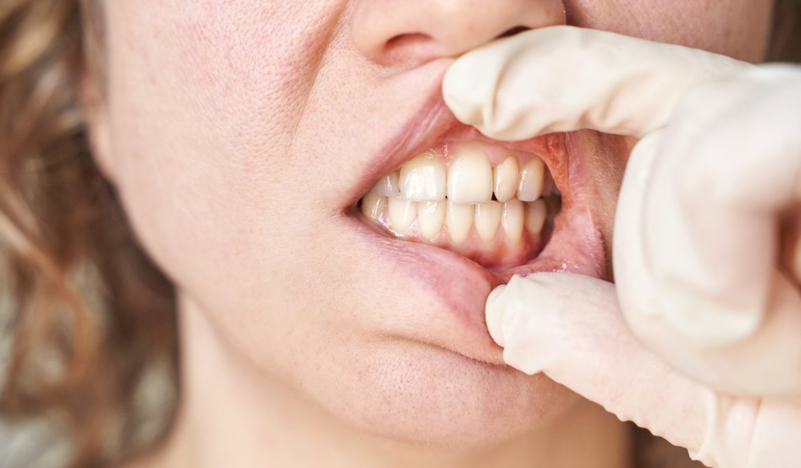 Αιμορραγία των Ούλων