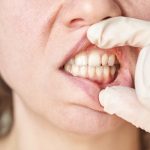 Αιμορραγία των Ούλων